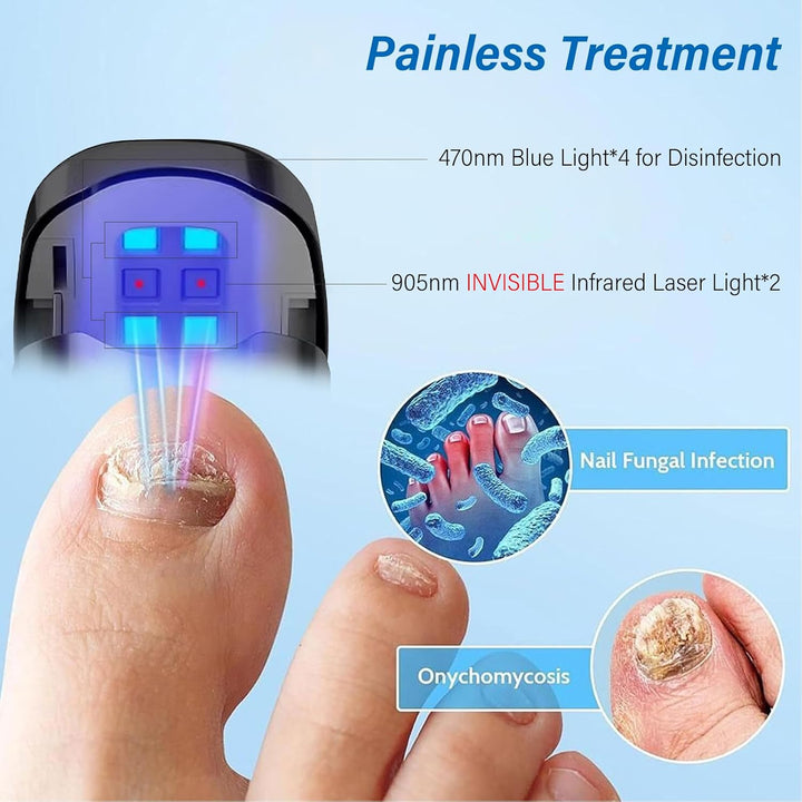 Nagelpilz Laser für Zuhause, Upgrade Nagelpilz Lasergerät【Upgrade 4*Blau & 2*Infrarotlicht】【Effektiv