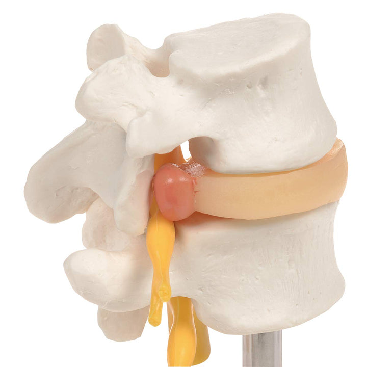 3B Scientific 3B Smart Anatomy Lendenwirbelsäule mit Bandscheibenvorfall + kostenlose Anatomie App -