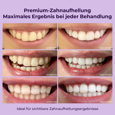 OnlySmile Teeth Whitening Gel für weisse Zähne | Zahnaufhellung und Bleaching Gel mit sofort Effekt