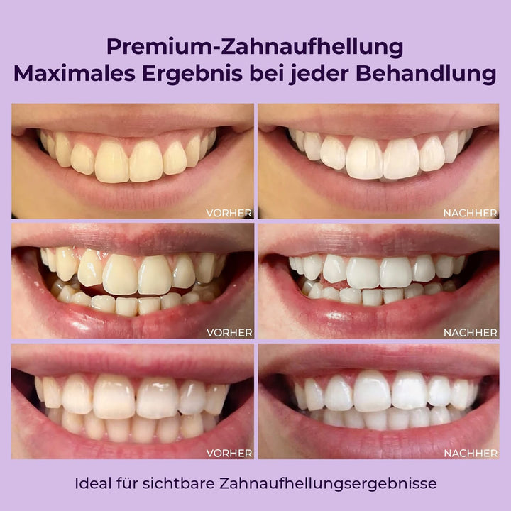 OnlySmile Doppelpack 2x Teeth Whitening Gel für weisse Zähne | Zahnaufhellung und Bleaching Gel mit