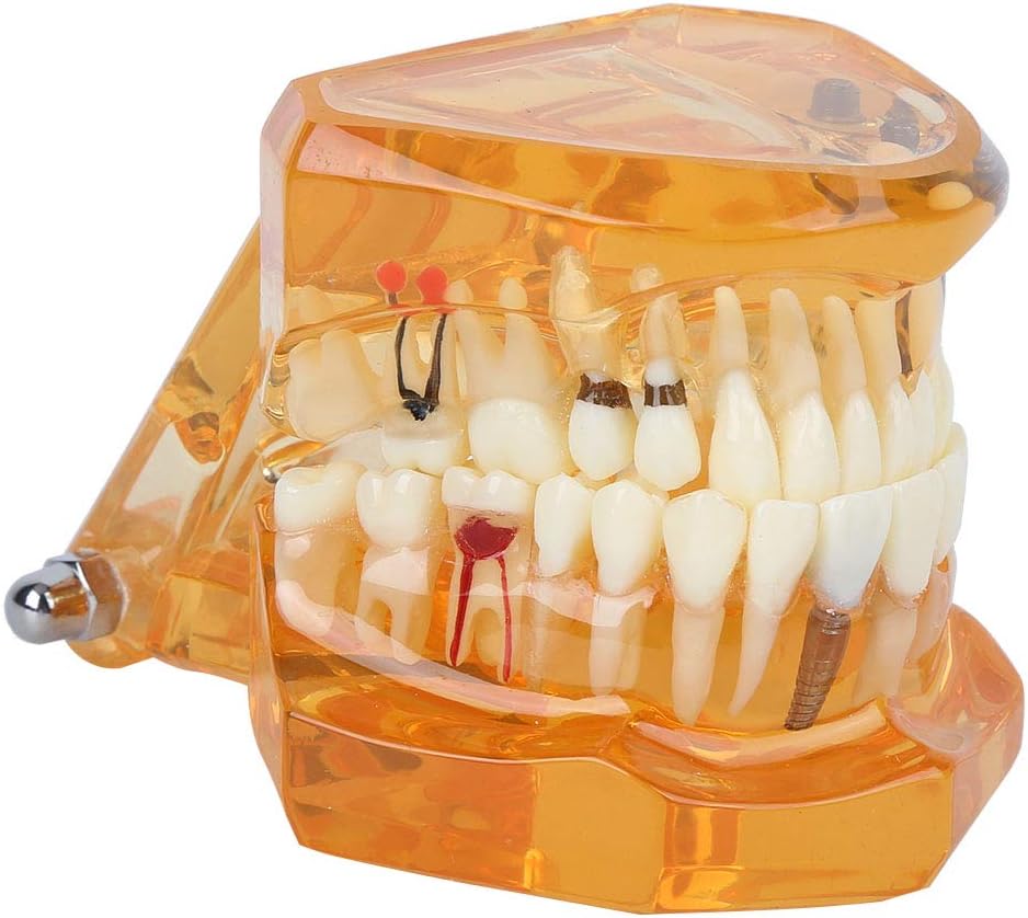 Natudeco Zahnärztliche Studienmodell untersuchen Modell Dental Maxillary Overdenture Model Minderwer