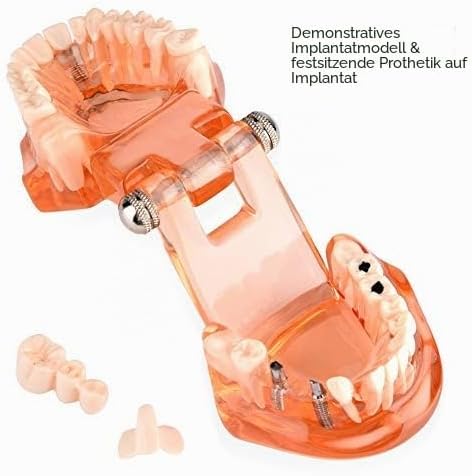 Jadeshay Zahnmodell Dentalmodell, Entfernbares Zahn-Implantat Lehrmodell Zahnarzt Demonstration Werk