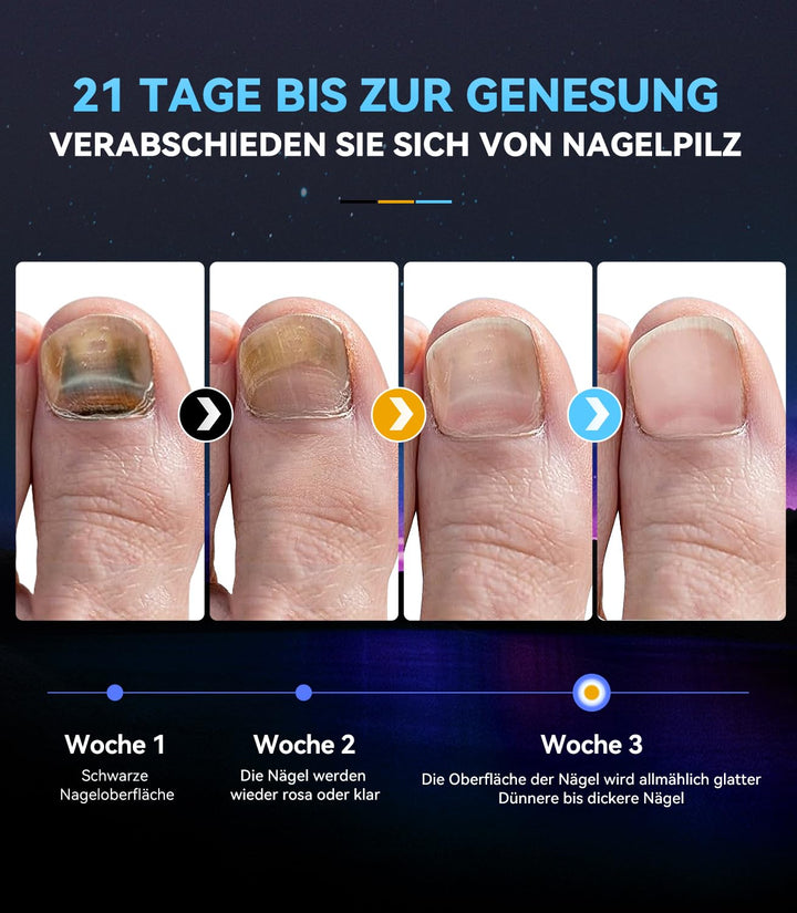 6.0 Nagelpilz Laser mit Zeitmessgerät Nagelpilz Lasergerät【3 Blau 1 Infrarot-Stärkste Wirkung】Laser