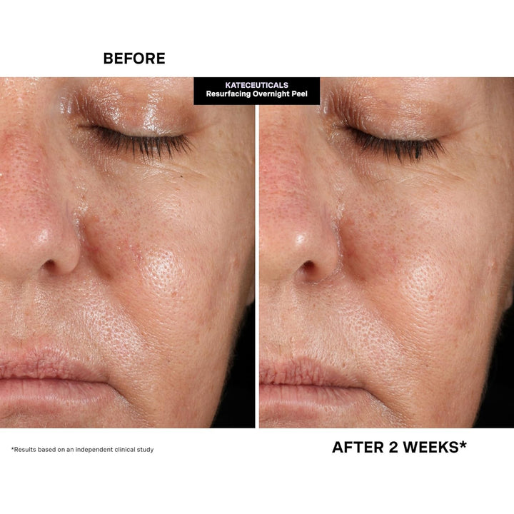 Kate Somerville KateCeuticals Resurfacing Overnight Peel | Klinikqualität Gesichtspeeling | leistung