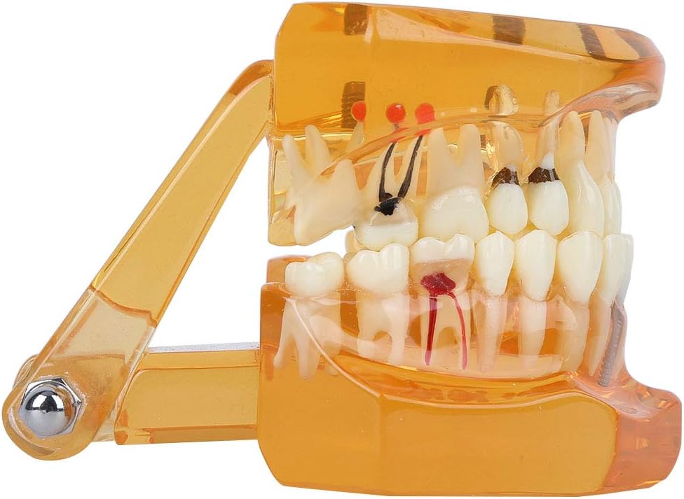 Zahnmodell Zahnkrankheits-Lehrmodell Abnehmbares Implantat Zahnmodell Mundmodell für Erwachsene für