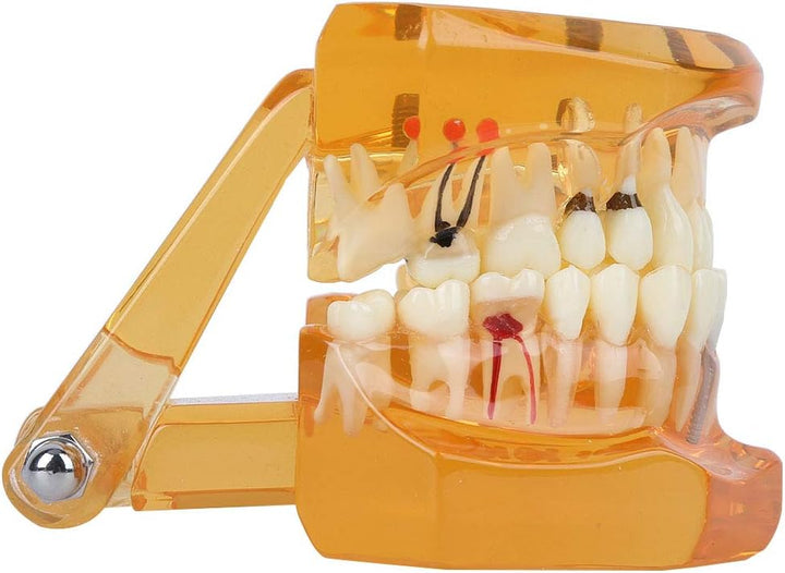 Zahnmodell Zahnkrankheits-Lehrmodell Abnehmbares Implantat Zahnmodell Mundmodell für Erwachsene für