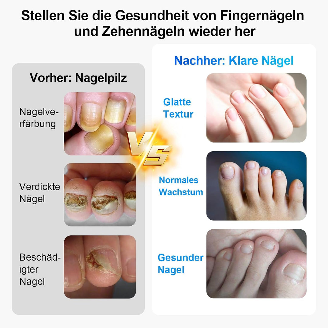LED Nagelpflegegerät, 500 nm Blaulicht und 940 nm Rotlicht, 21 Tage, für Finger- und Zehennägel, mit