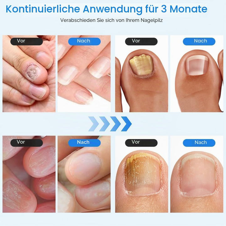 Nagelpilz Laser Gerät mit Zeitanzeige, Lichttherapiegerät für Nagelpilz, Nagelpilz-Laser, Nagelpilz