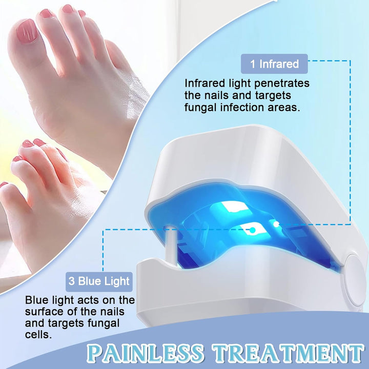 Upgrade Nagelpilz Lasergerät mit Zeitanzeige,Nagelpilz Laser mit Zeitmessgerät, Nagelpilz Behandlung