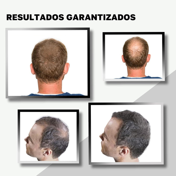 VidalForce. Streuhaar Schwarz 30gr I 100% Natürlich Ansatzpuder I Dichtes Haar in 20 Sekunden I Ansa