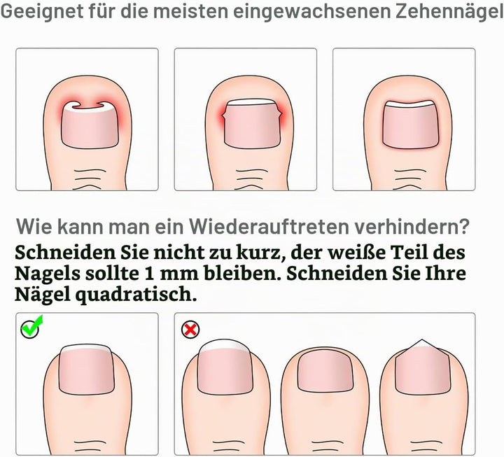 Supvox Zehennagel Korrektur Aufkleber Eingewachsener Zehennagel Fussnagel Korrektur Fusspflege Pedik
