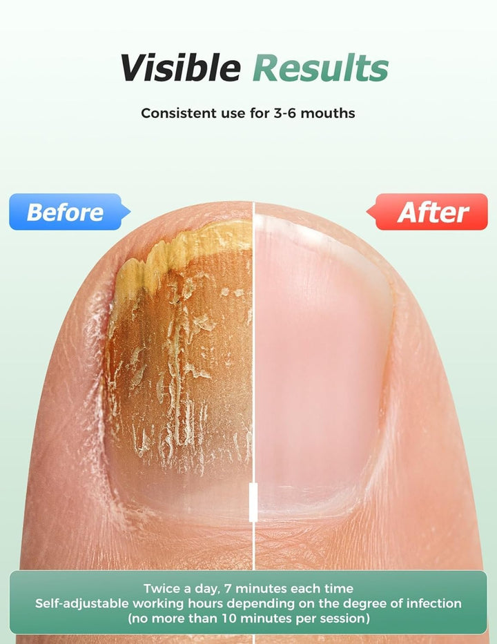 2025 Upgrade Nagelpilz Lasergerät, Nagelpilz Laser Gerät für Mehrere &amp; Fingernägel Lichttherapiegerä