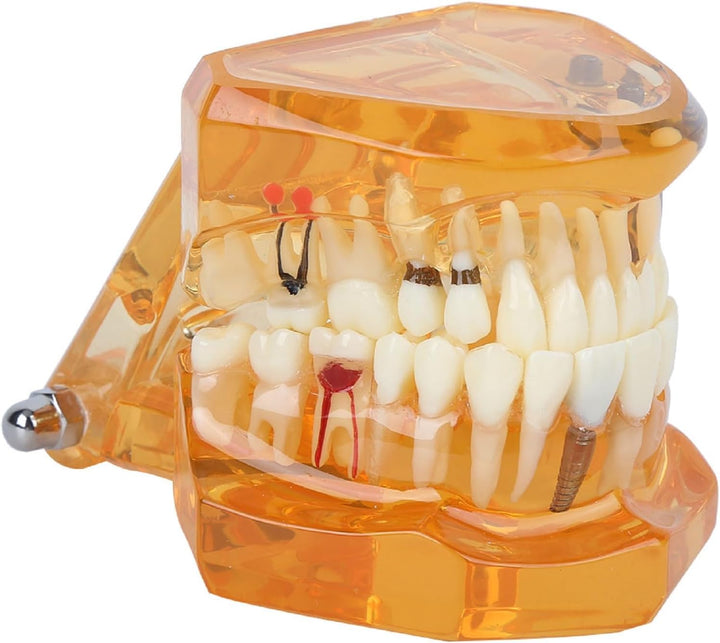 Natudeco Zahnärztliche Studienmodell untersuchen Modell Dental Maxillary Overdenture Model Minderwer