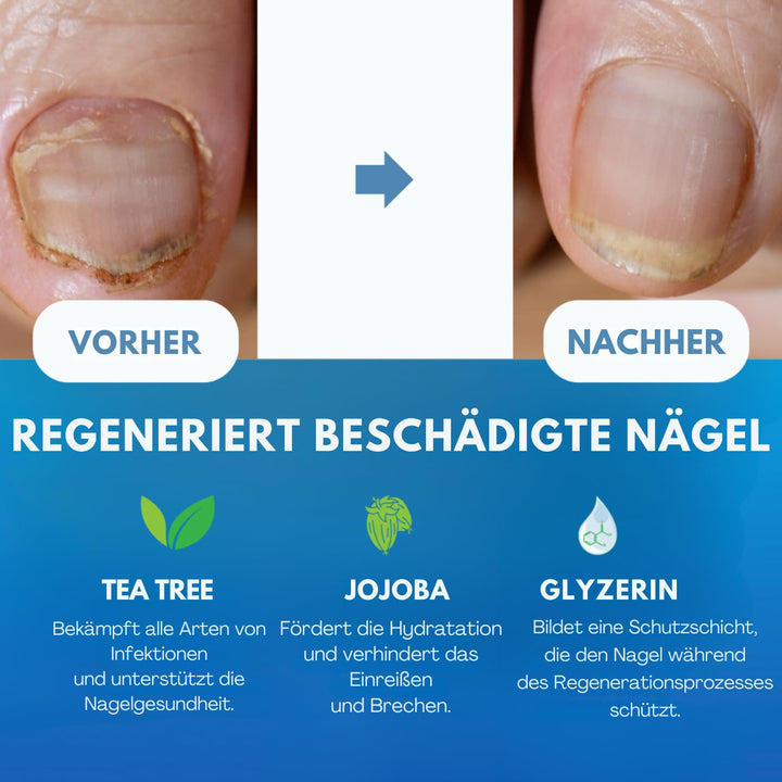 Imperial Feet Nagelhärter Ideales Zehennagelpflege-Set - Nagelpflegeprodukte für verfärbte, brüchige