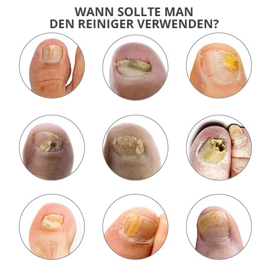 Nagelpilz Behandlung-PodermProfessional 30ml | Revitalisierender | Professionelle Fuss/Handpflege |