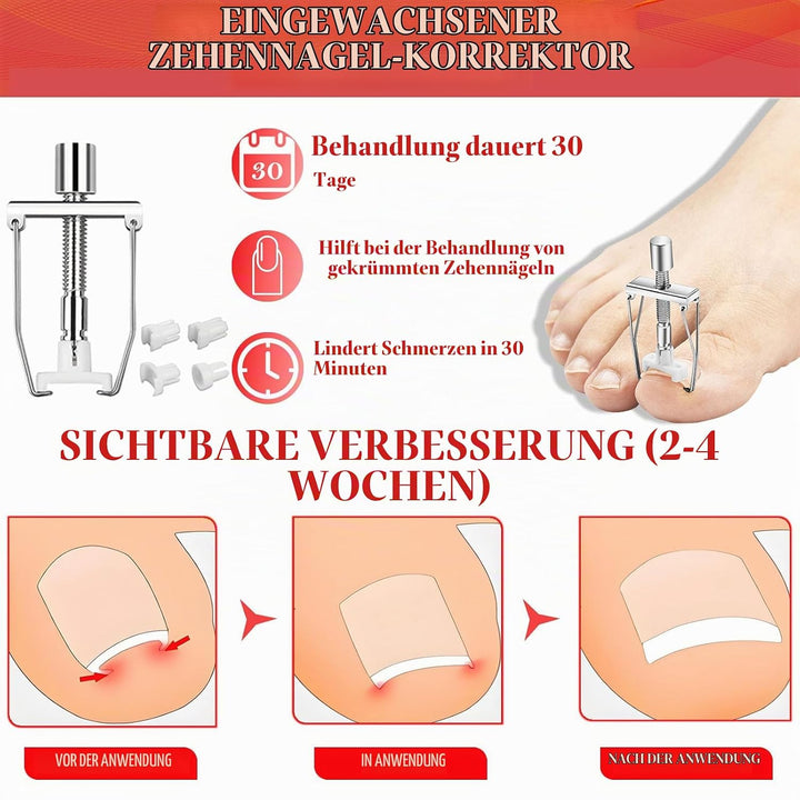 Ingrown Toenail Treatment, ELALRAU Ingrown Toenail Removal Kit with Ingrown Toenail Corrector Drops,