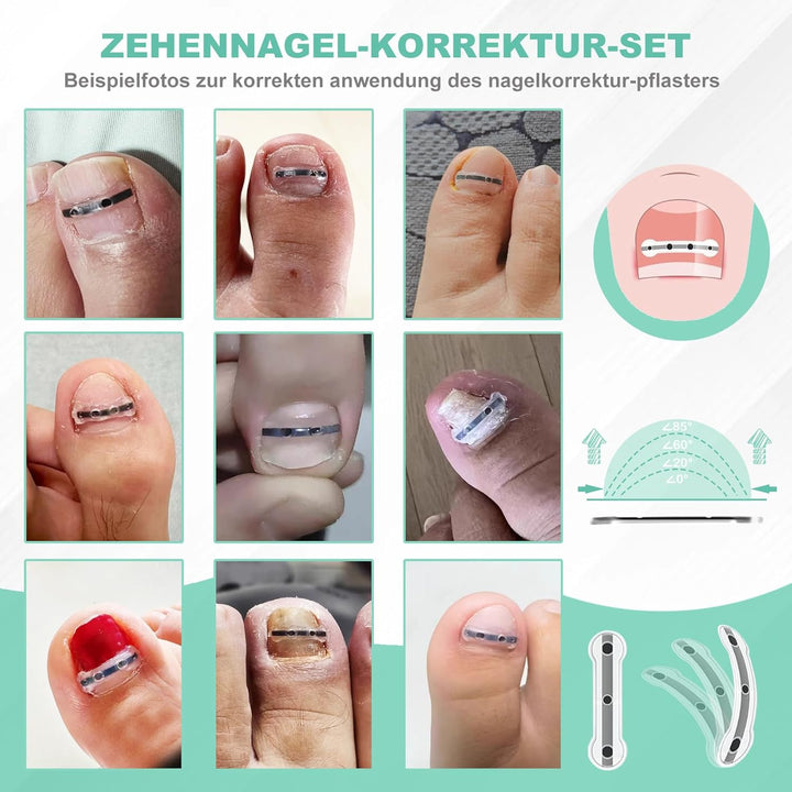 Eingewachsene Zehennägel Set Zehennagel Korrektur Patch 9pcs Nagelspange Fussnägel Zehennagelheber W