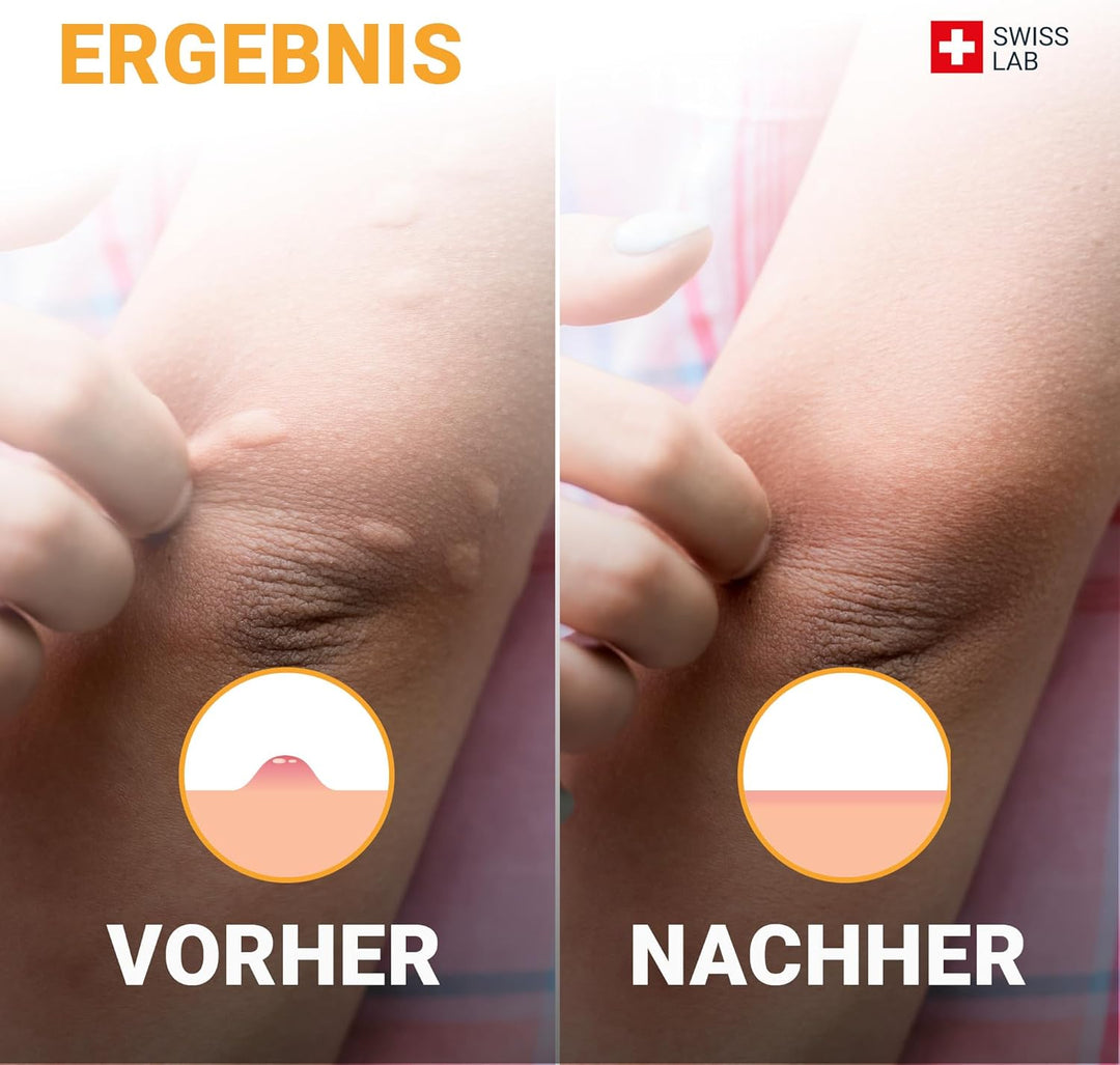ROLL-ON Apaisant Bettwanzenbisse - Lindert Bettwanzenbisse sofort - 5mL