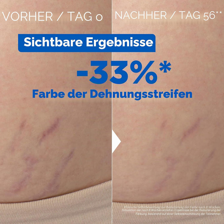 Mixa - Körperöl gegen Dehnungsstreifen - 30% Omega-6 & 9 - Reduziert Farbe, Textur und Dicke von Deh