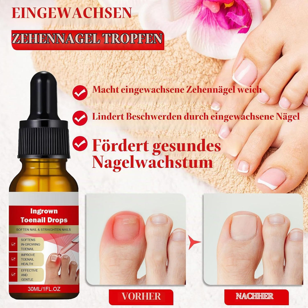 Ingrown Toenail Treatment, ELALRAU Ingrown Toenail Removal Kit with Ingrown Toenail Corrector Drops,
