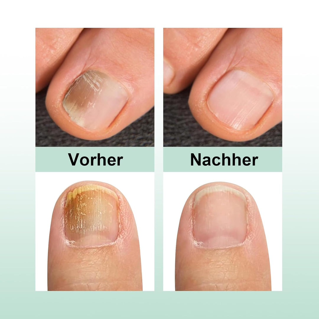 Nail Care Pen, Das Original Nail Care Pen Für Fingernägel &amp; Fussnägel, Nail Care Stift öSterreich, N