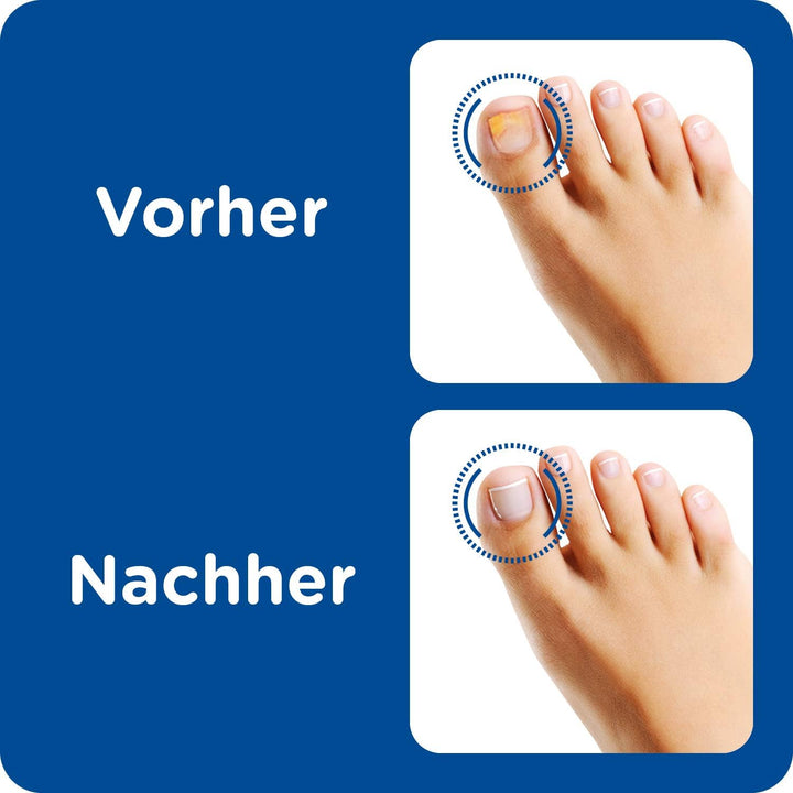 Anti Nagelpilz Stift (4ml) · Burgit · Schnelle Pilzbehandlung · Bei Nagelinfektionen · Verfärbte Ver