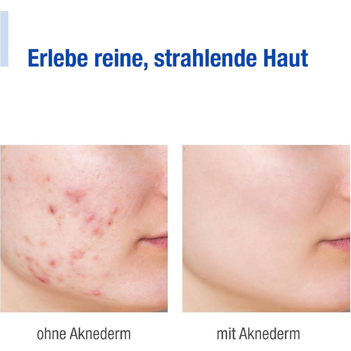 Aknederm mattierende Gesichtslotion gegen Pickel & Akne 2 x 30ml - Tageslotion für normale bis fetti
