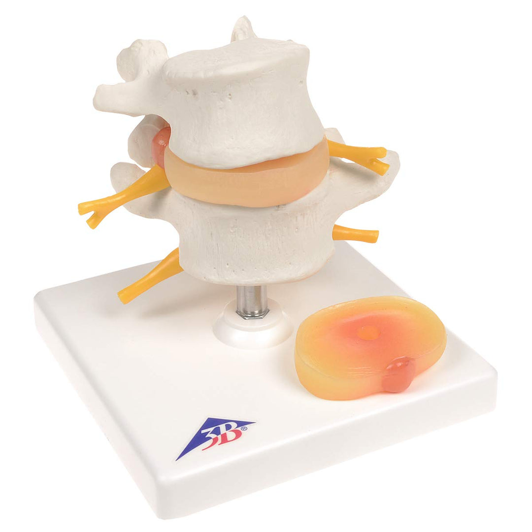 3B Scientific 3B Smart Anatomy Lendenwirbelsäule mit Bandscheibenvorfall + kostenlose Anatomie App -