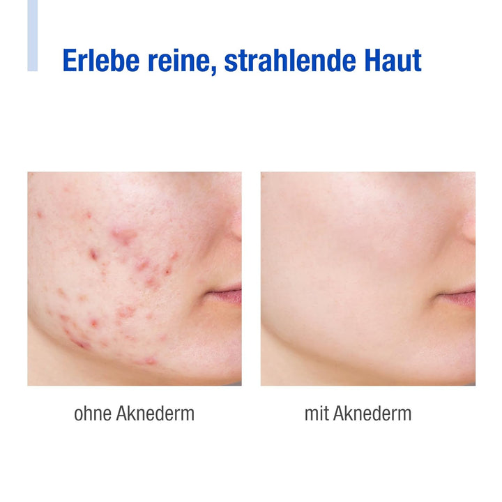 AKNEDERM Premium Set for normal skin, 780