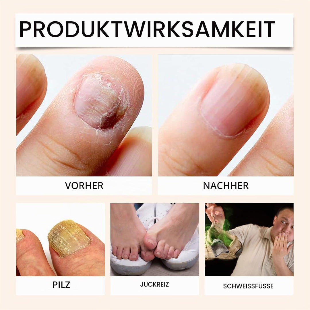 Propolis Nagelserum, Bienengift Nagel-Reparatur Spray, Sanfte Pflege Eingewachsener Nägel und Sauber