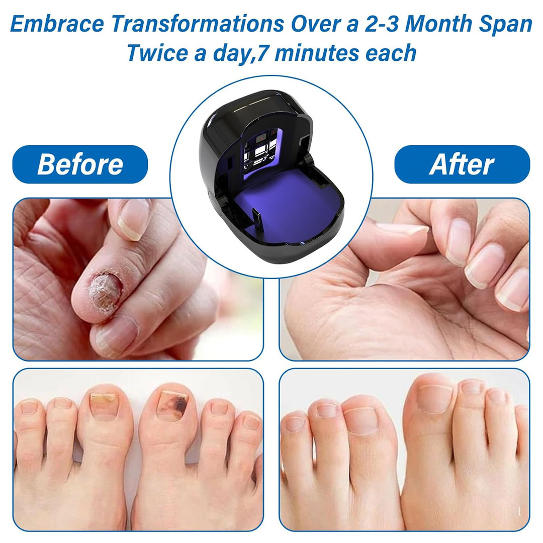 Nagelpilz Laser für Zuhause, Upgrade Nagelpilz Lasergerät【Upgrade 4*Blau & 2*Infrarotlicht】【Effektiv
