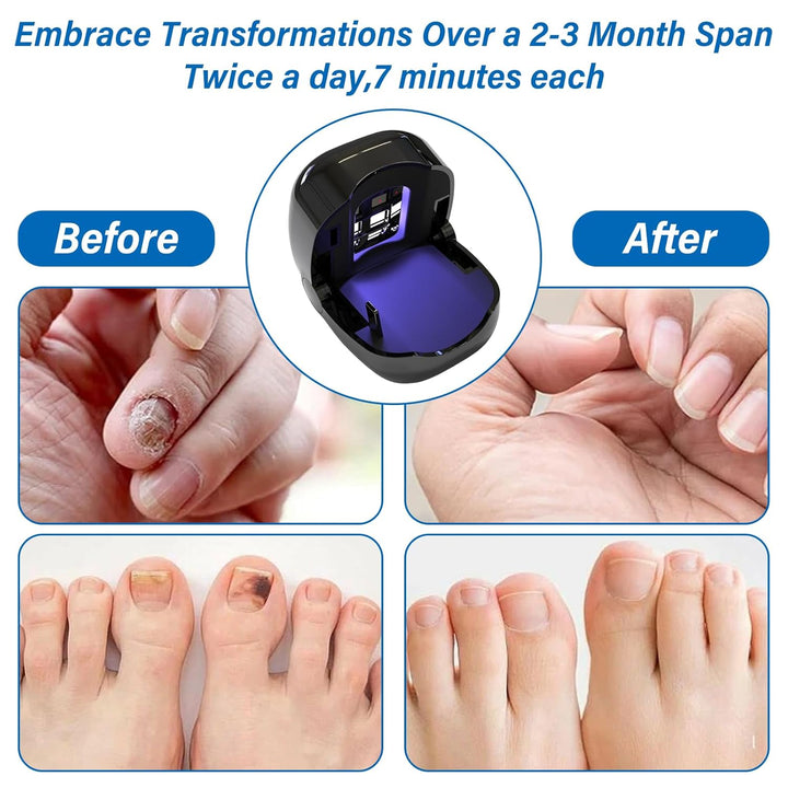 Nagelpilz Laser für Zuhause, Upgrade Nagelpilz Lasergerät【Upgrade 4*Blau & 2*Infrarotlicht】【Effektiv