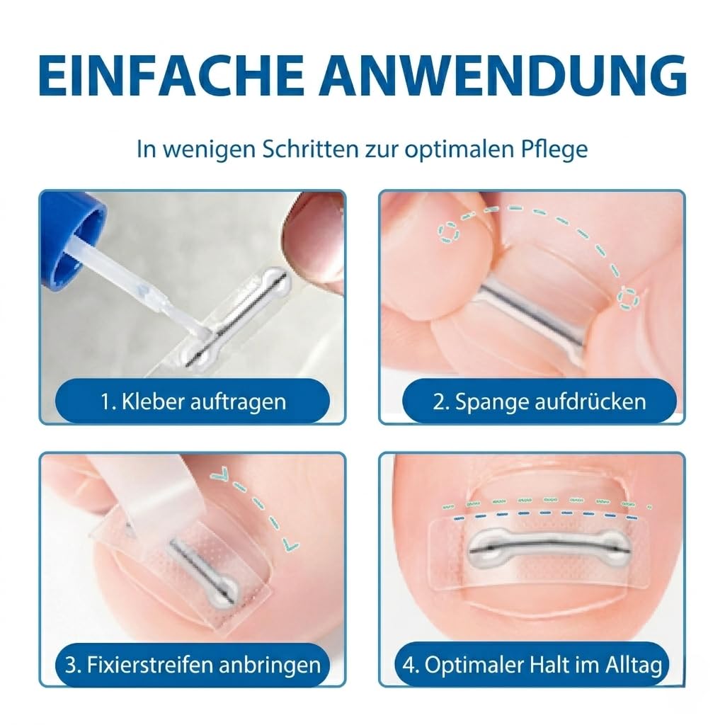 Eingewachsene Zehennägel Set Titan Nagelspange Fussnägel Korrektur, 10 Stück | 1er Pack, 5 Grössen 1
