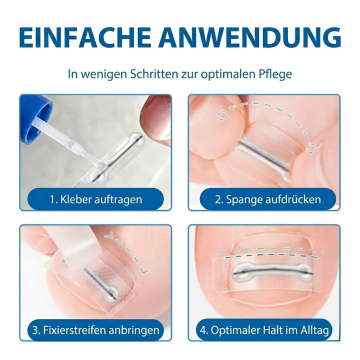 Eingewachsene Zehennägel Set Titan Nagelspange Fussnägel Korrektur, 10 Stück | 1er Pack, 5 Grössen 1