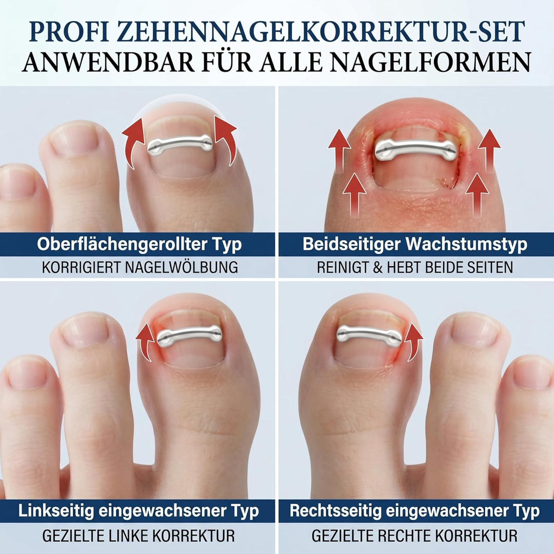 Eingewachsene Zehennägel Set, Zehennägel Korrektur Patch, Nagelspange Fussnägel, Entwickelt für Eing