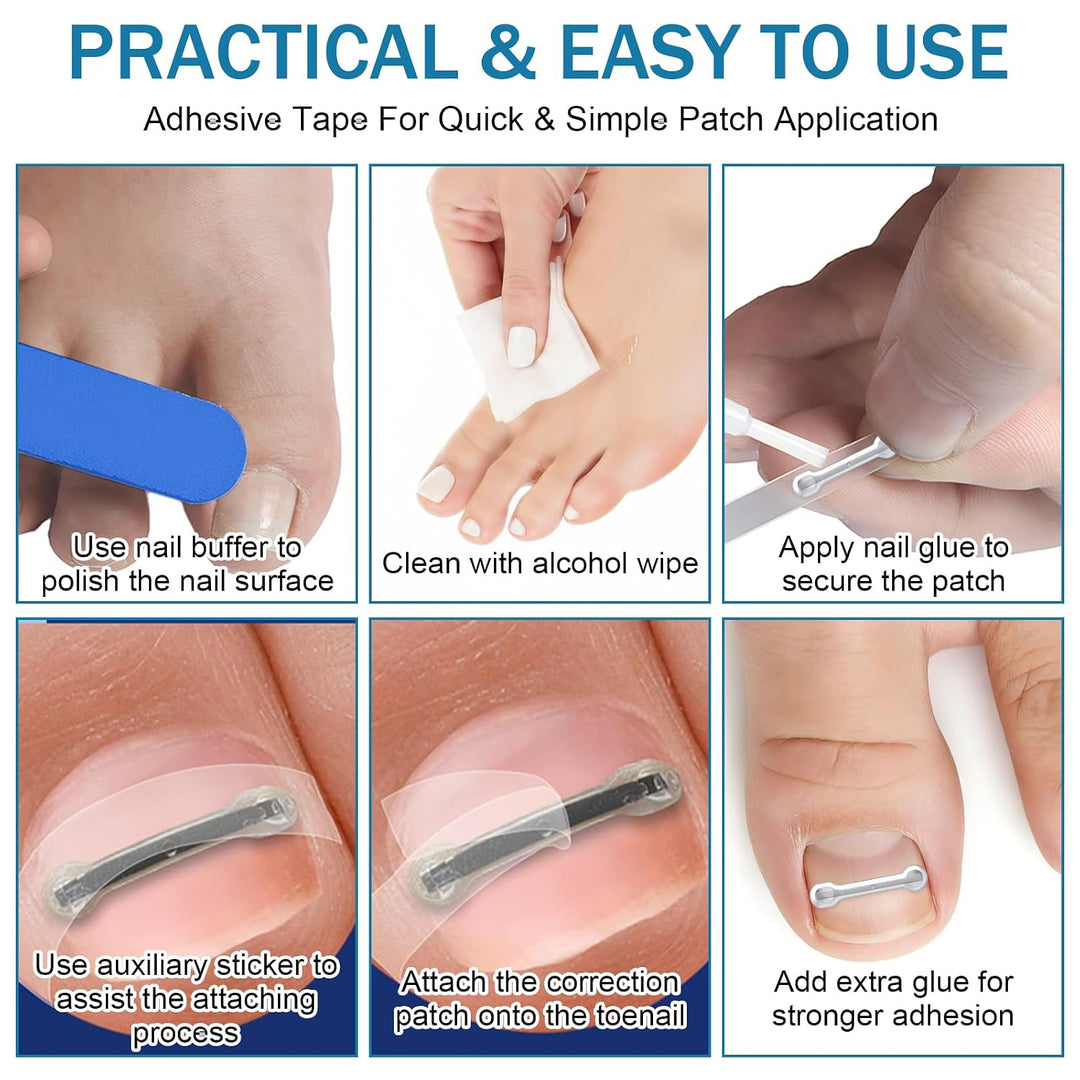 Eingewachsene Zehennägel Set, Zehennägel Korrektur Patch, Nagelspange Fussnägel Eingewachsener Zehna