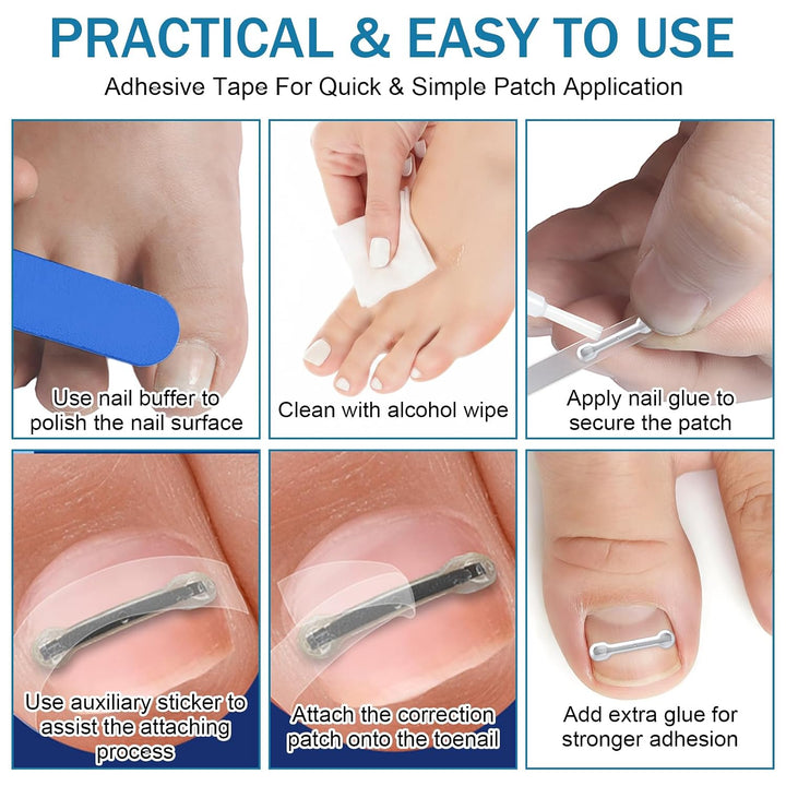 Eingewachsene Zehennägel Set, Zehennägel Korrektur Patch, Nagelspange Fussnägel Eingewachsener Zehna