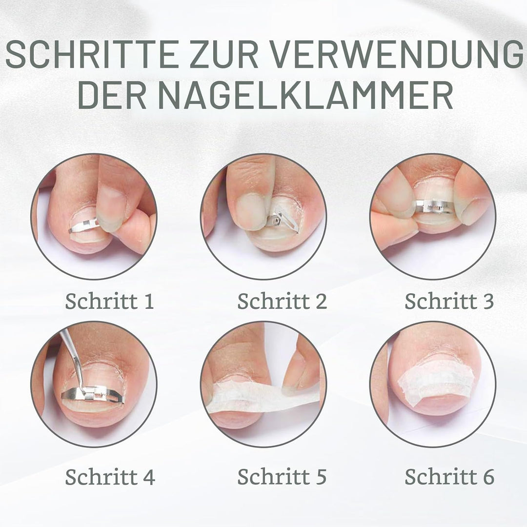 4 Stück Eingewachsene Zehennägel Set Fussnagel Eingewachsen Spange Nagelspangen Für Fussnägel Zehenn