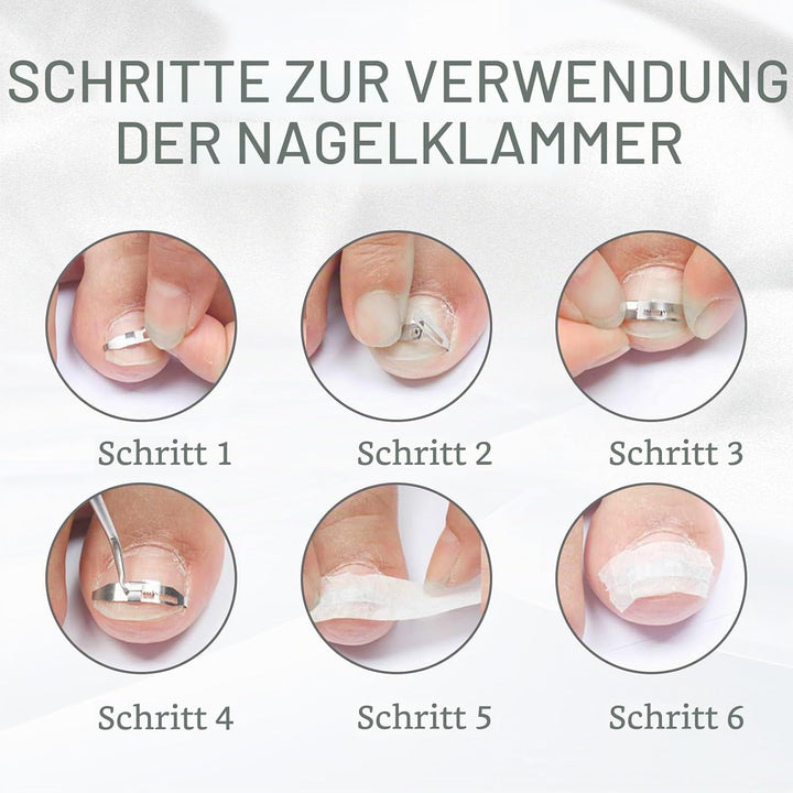 4 Stück Eingewachsene Zehennägel Set Fussnagel Eingewachsen Spange Nagelspangen Für Fussnägel Zehenn