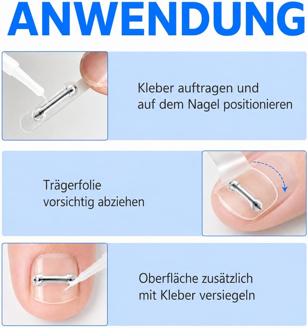 Eingewachsene Zehennägel Set, Universal Nagelspange Fussnägel Korrektu | Fünf Verschiedene Grössen,
