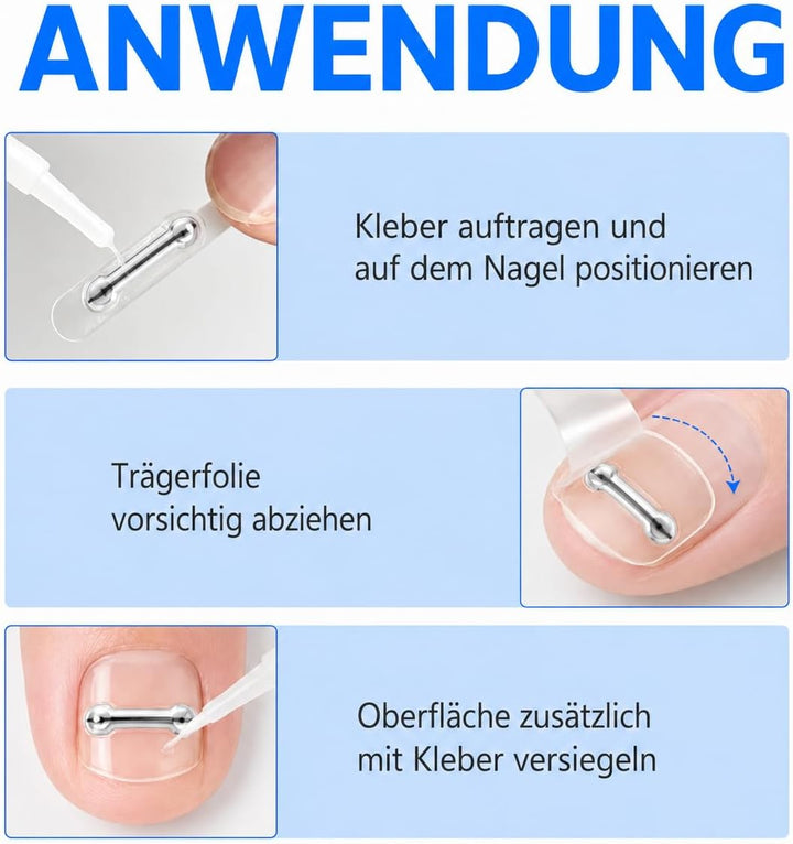 Eingewachsene Zehennägel Set, Universal Nagelspange Fussnägel Korrektu | Fünf Verschiedene Grössen,