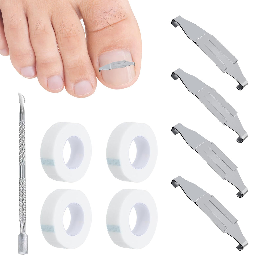4 Stück Eingewachsene Zehennägel Set Fussnagel Eingewachsen Spange Nagelspangen Für Fussnägel Zehenn