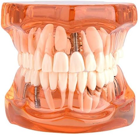 Jadeshay Zahnmodell Dentalmodell, Entfernbares Zahn-Implantat Lehrmodell Zahnarzt Demonstration Werk