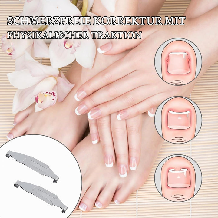 4 Stück Eingewachsene Zehennägel Set Fussnagel Eingewachsen Spange Nagelspangen Für Fussnägel Zehenn