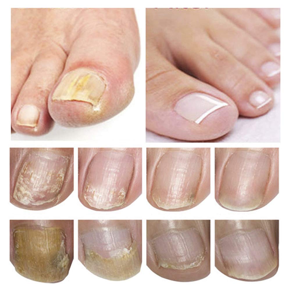 Nagelpflege und Behandlung, Nagelpflege für gesunde Fuss und Hand, Nagelpflegeöl,Nagelpflege pflegen