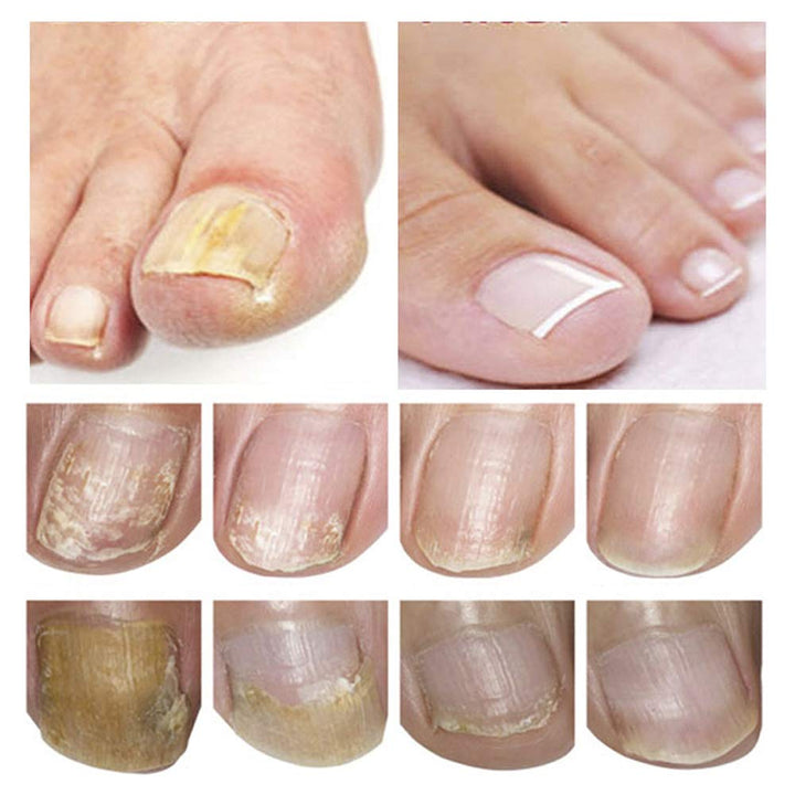 Nagelpflege und Behandlung, Nagelpflege für gesunde Fuss und Hand, Nagelpflegeöl,Nagelpflege pflegen