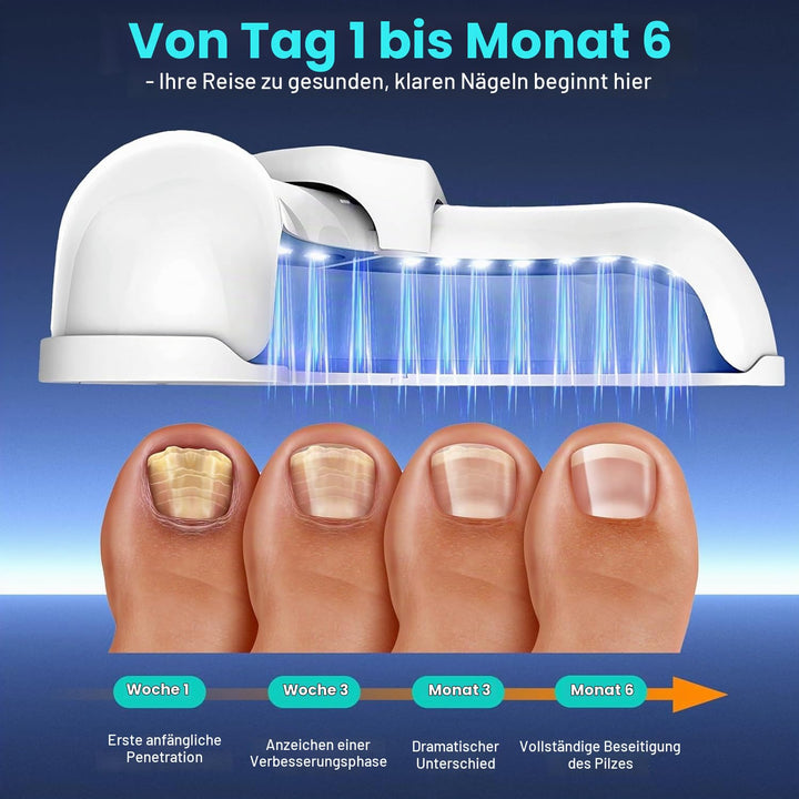 2025 Upgrade Nagelpilz Lasergerät, Nagelpilz Laser Gerät für Mehrere &amp; Fingernägel Lichttherapiegerä
