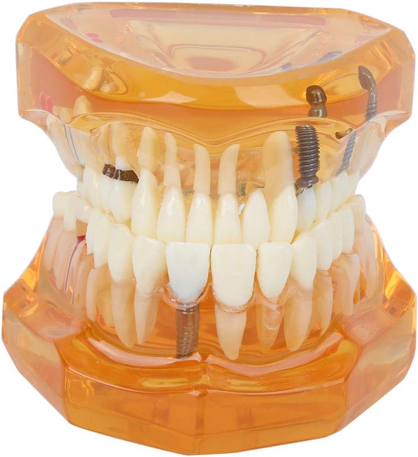 Natudeco Zahnärztliche Studienmodell untersuchen Modell Dental Maxillary Overdenture Model Minderwer