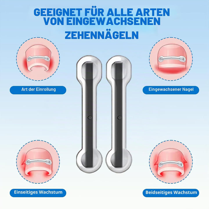 Eingewachsene Zehennägel Werkzeug Set, Nagel-korrekturspange, Zehennägel Korrektur Patch, Nagelspang