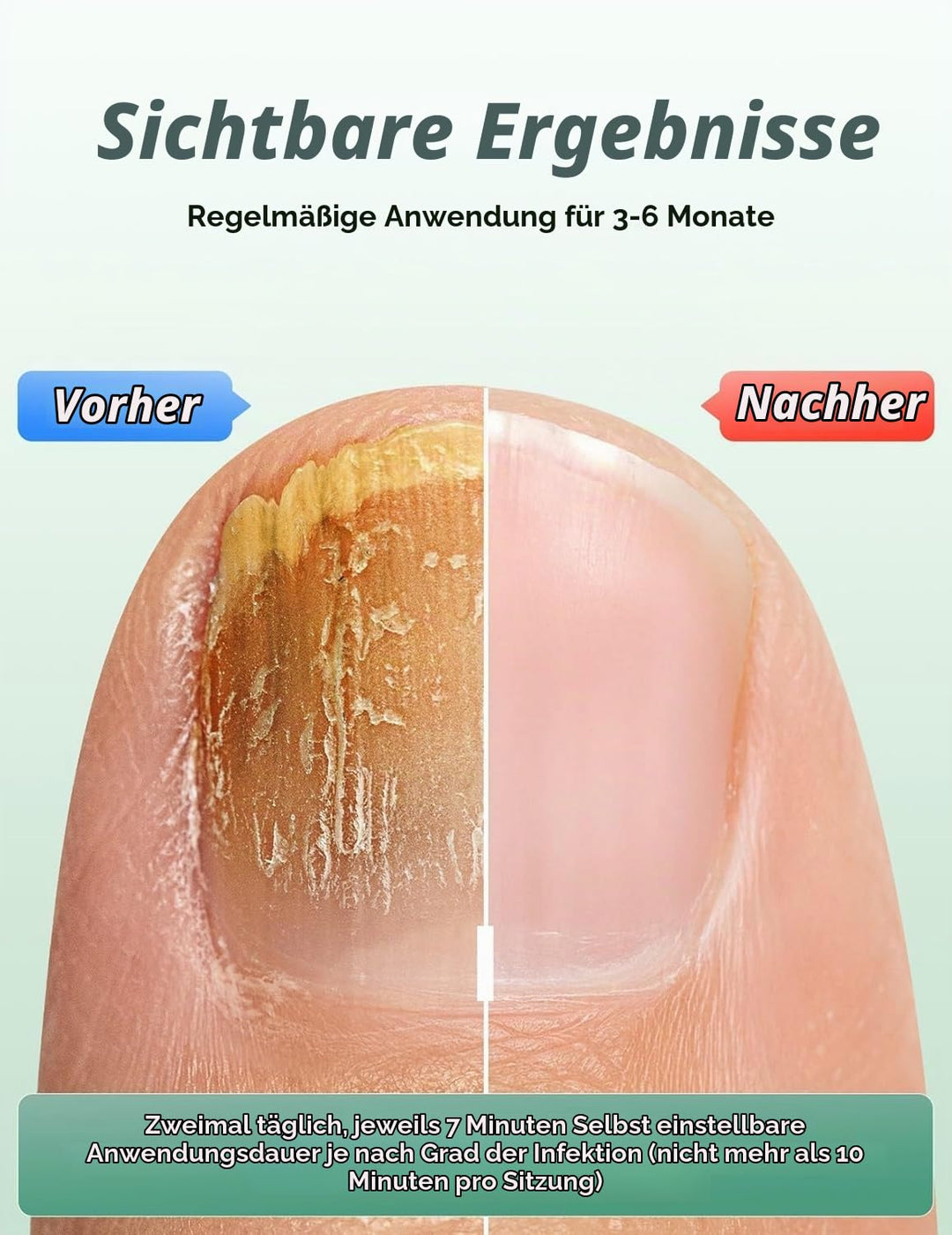 2025 Upgrade Nagelpilz Lasergerät, Nagelpilz Laser Gerät für Mehrere &amp; Fingernägel Lichttherapiegerä